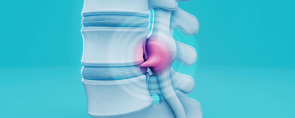 Sciatica Treatment in Hyderabad